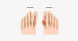 2 Pack: Comfort Healing Toe Separators and Bunion Spacers - FREE SHIP DEALS