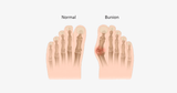 2 Pack: Comfort Healing Toe Separators and Bunion Spacers - FREE SHIP DEALS